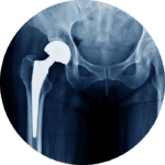 X-ray showing a metal hip replacement implant in a patient.
